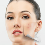 Sẹo thâm để lại trên da mặt do mụn